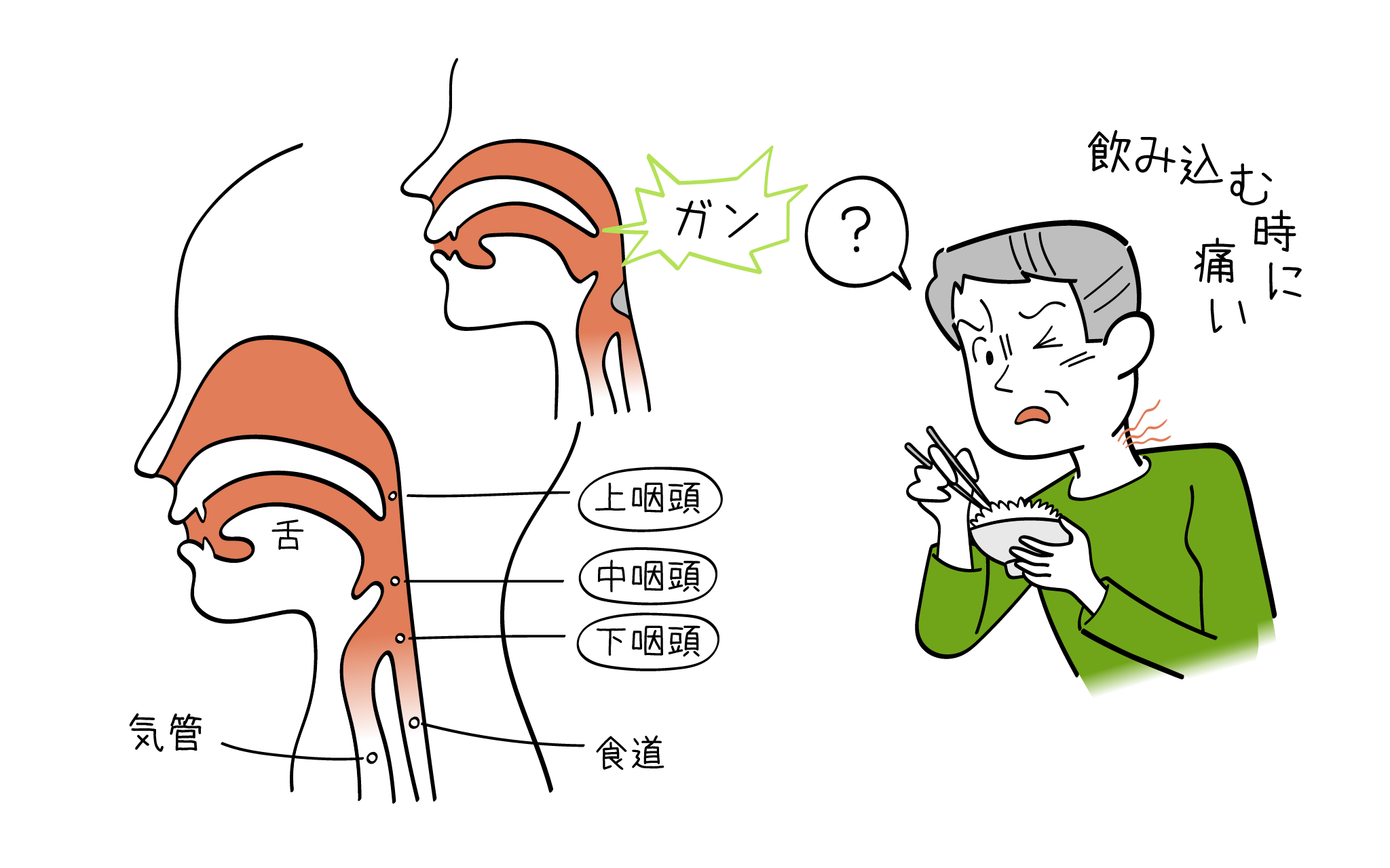 咽頭がんの診断治療について、耳鼻科専門医が詳しく解説。