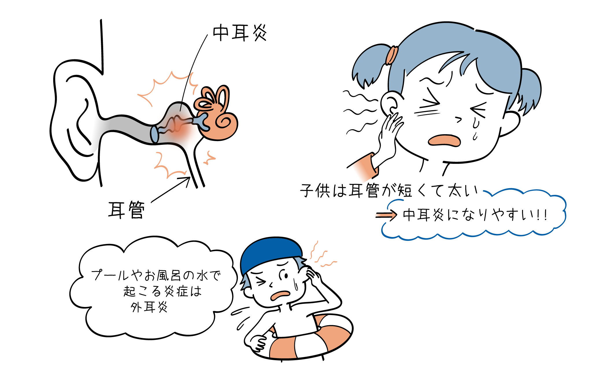 こどもの中耳炎について、こころみクリニックの小児科専門医が解説します。
