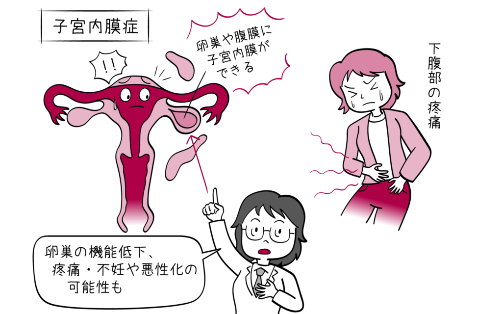 子宮内膜症の原因症状診断治療について、婦人科専門医が解説します。
