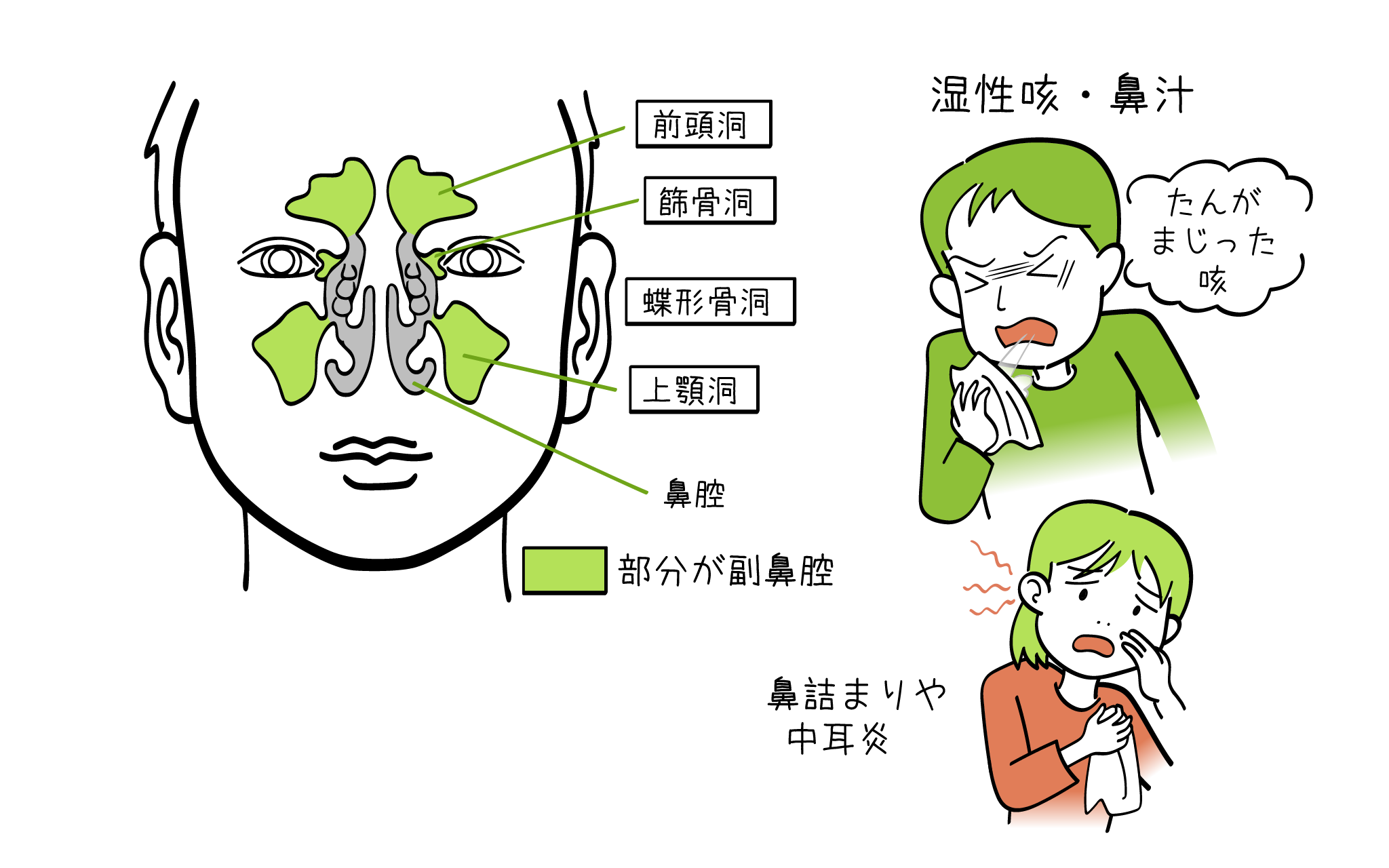 慢性副鼻腔炎について、こころみクリニックの耳鼻科専門医が解説。