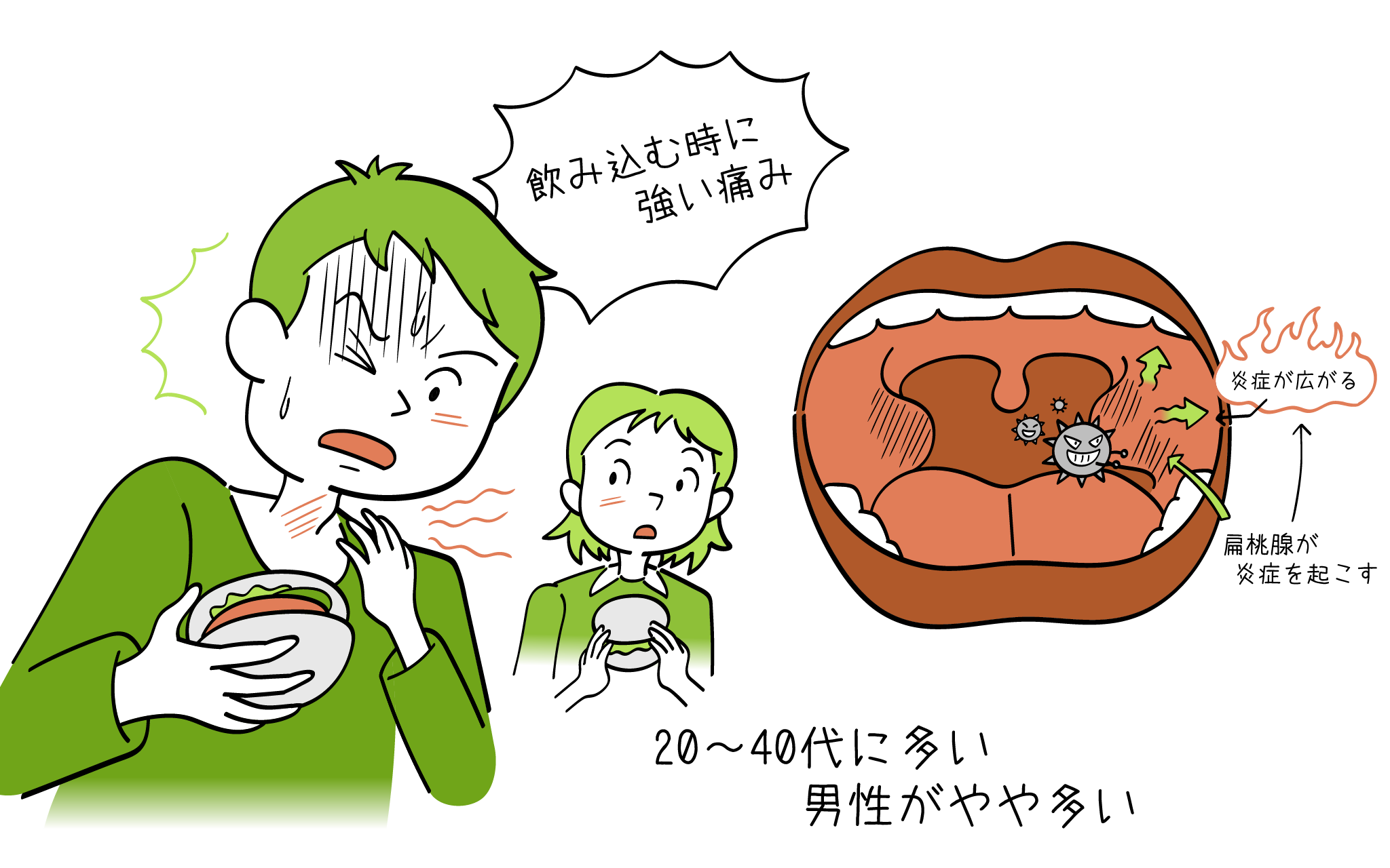 扁桃周囲膿瘍について、耳鼻科専門医が詳しく解説。