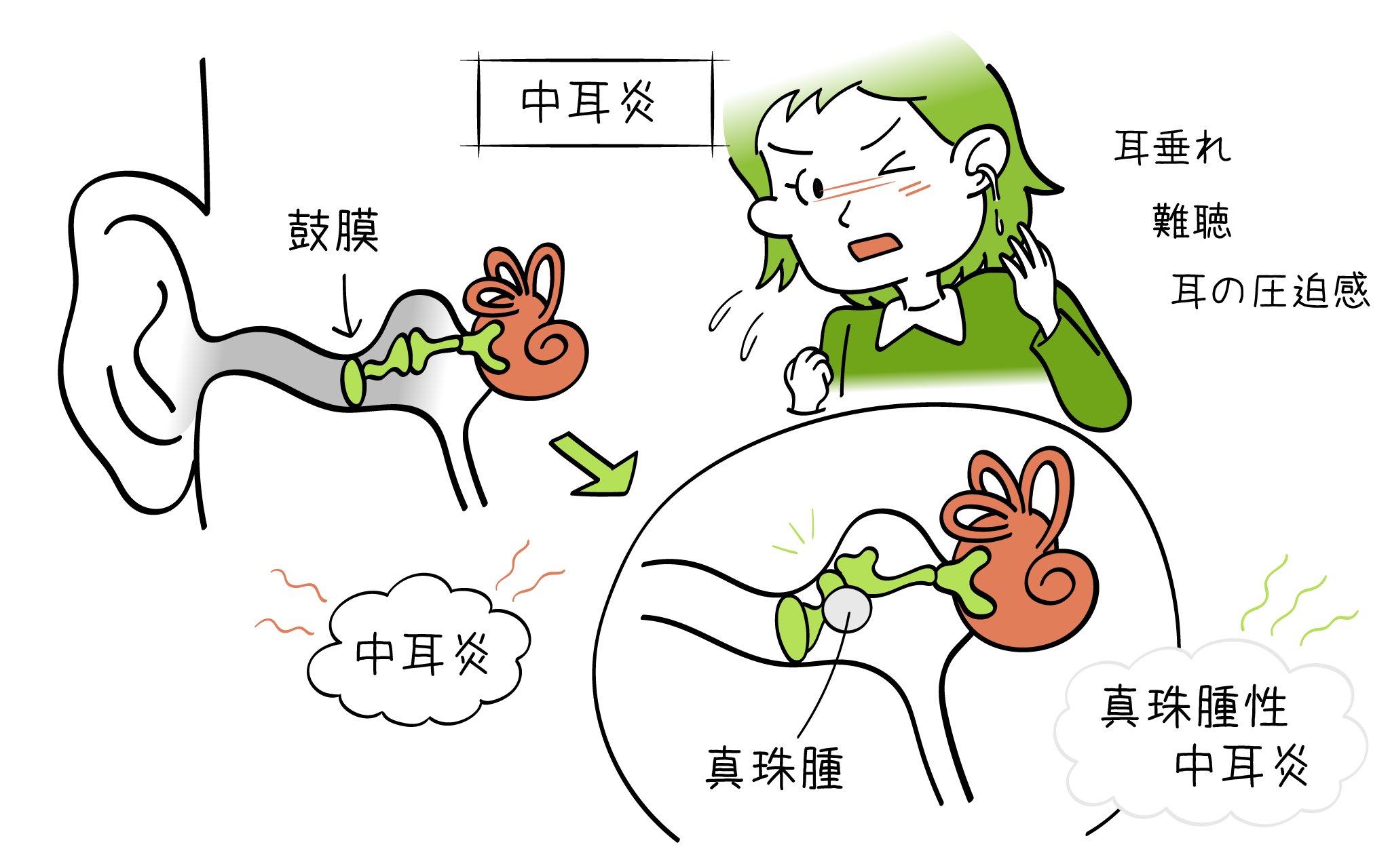 慢性中耳炎の症状治療について、元住吉院の耳鼻科専門医が解説します。