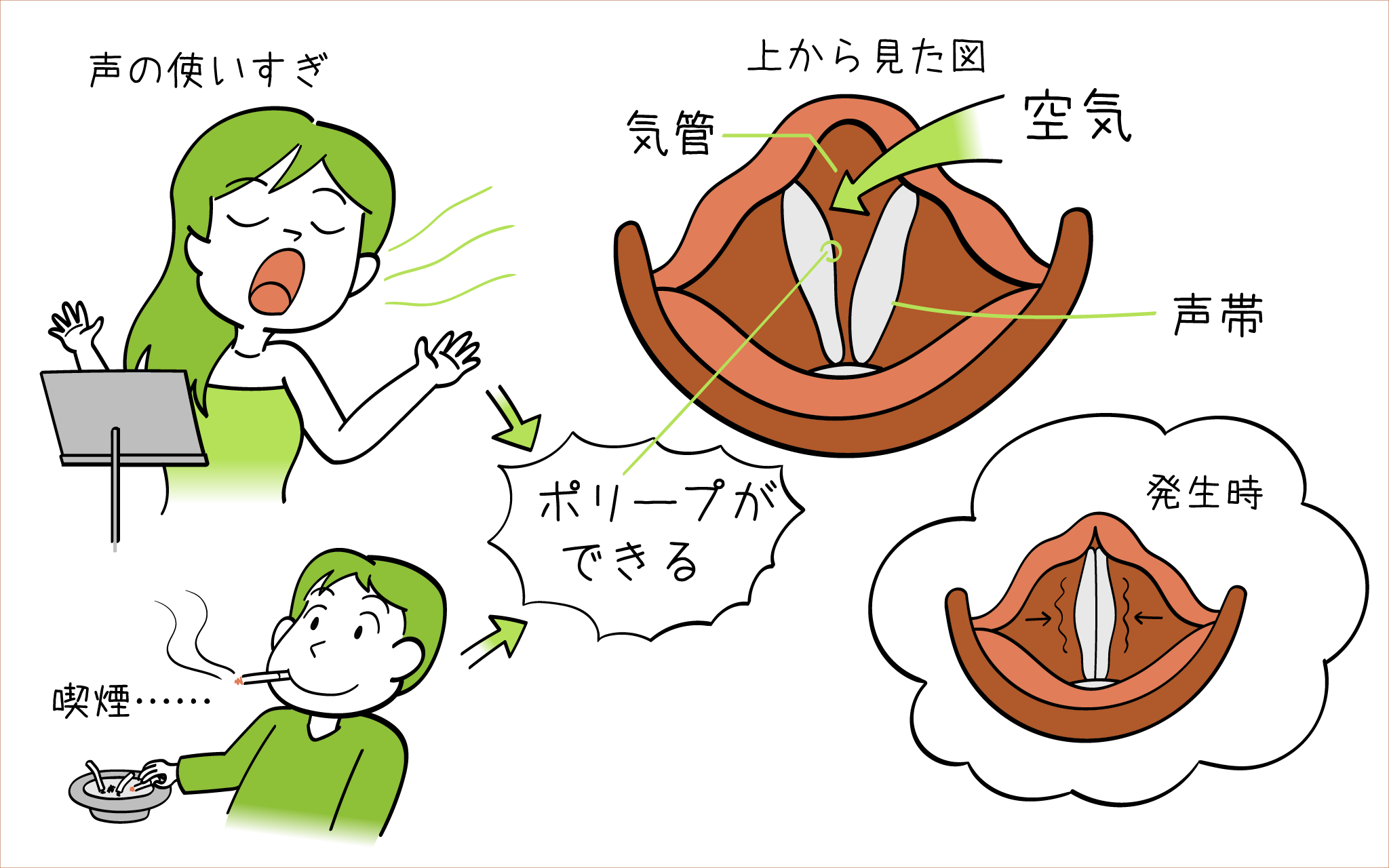 声帯ポリープについて、こころみクリニック耳鼻科専門医が解説します。