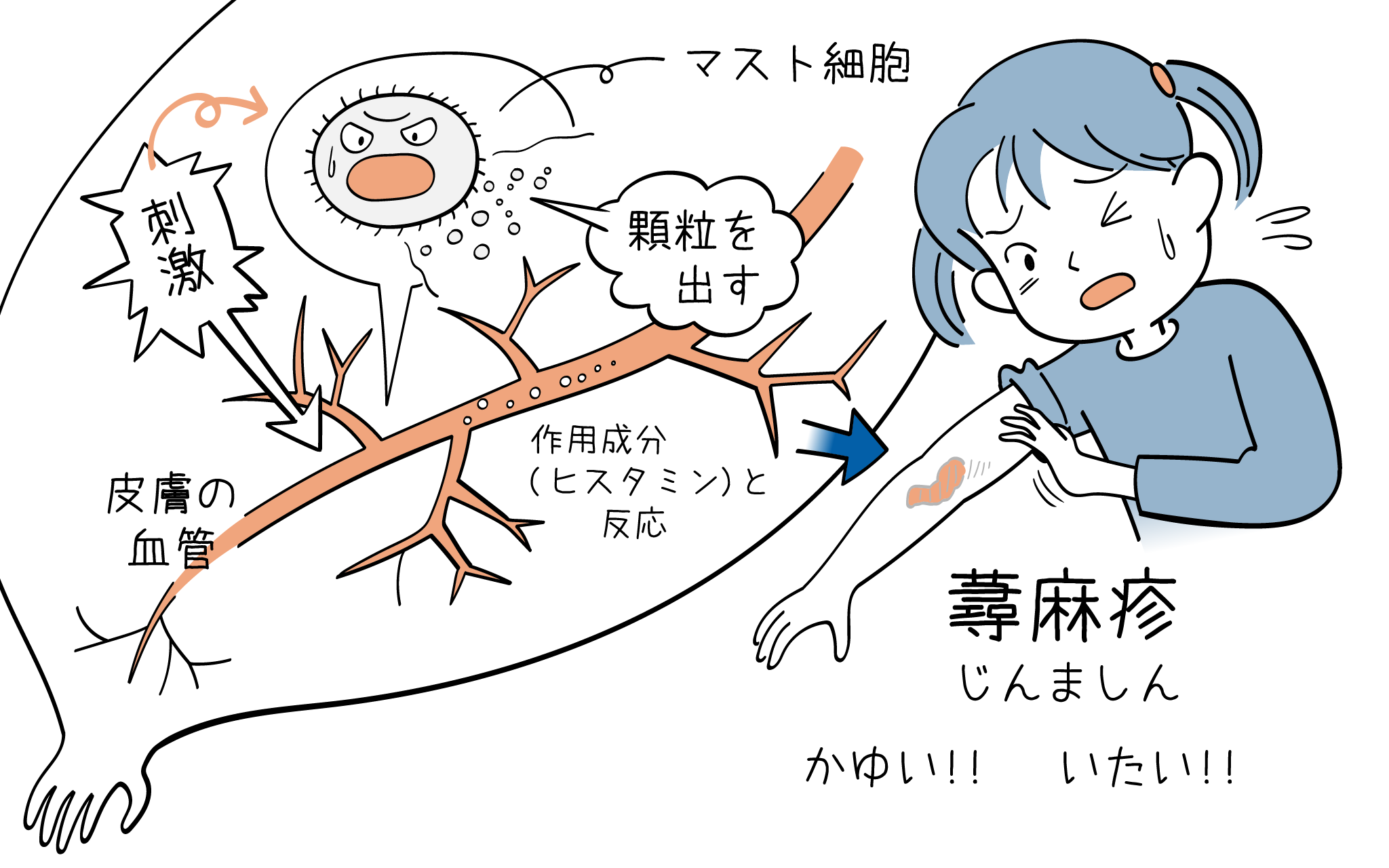 蕁麻疹について、こころみクリニックの小児科専門医が詳しく解説。