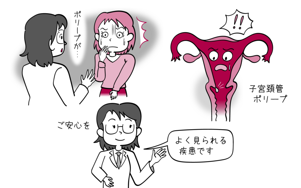 子宮頚管ポリープについて、婦人科専門医が解説。