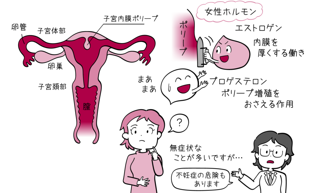 子宮内膜ポリープについて、婦人科専門医が解説します。