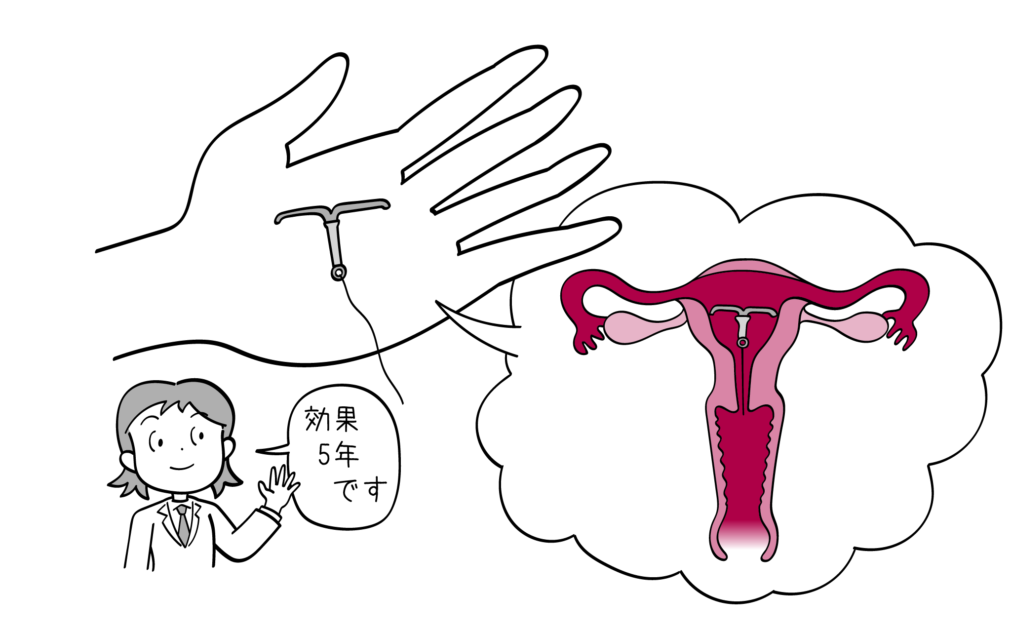 ミレーナについて、元住吉院の婦人科専門医が解説。