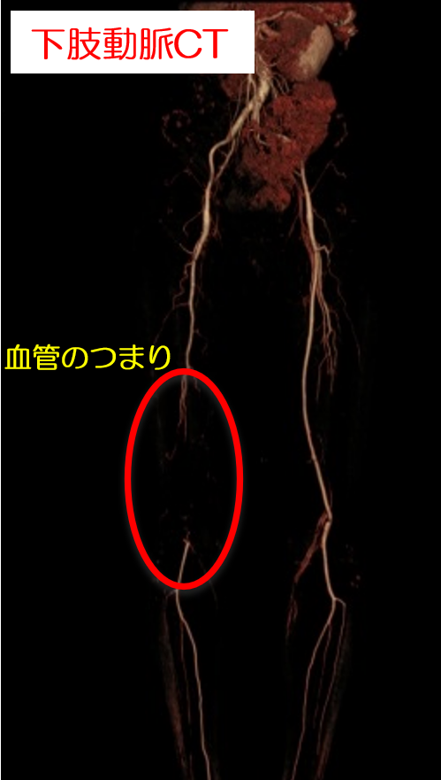 下肢動脈の造影CTでは閉塞が明確になります。