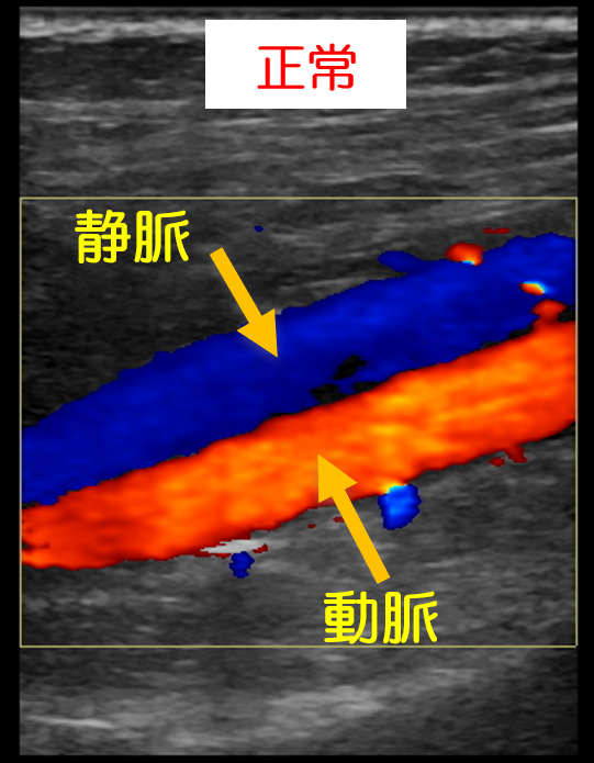 正常な下肢静脈のエコー画像を示します。