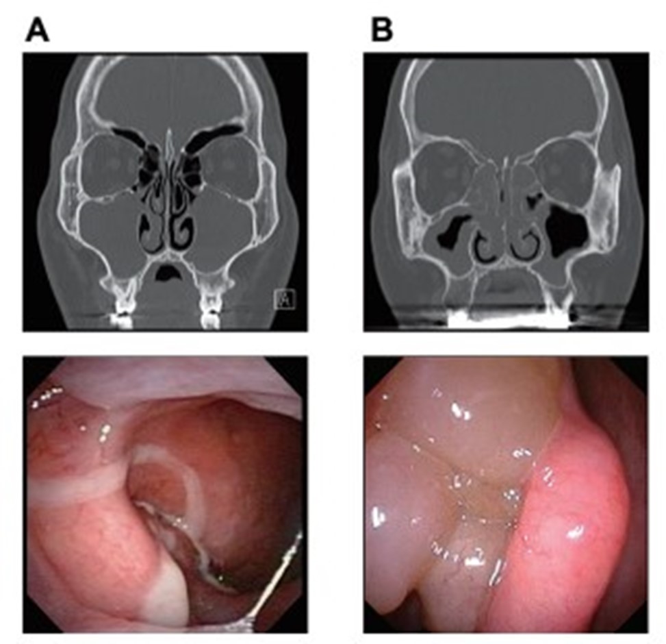 引用)*3〔専攻医トレーニング講座〕慢性副鼻腔炎の病態分類.日耳鼻.2022:125;1600-1603.