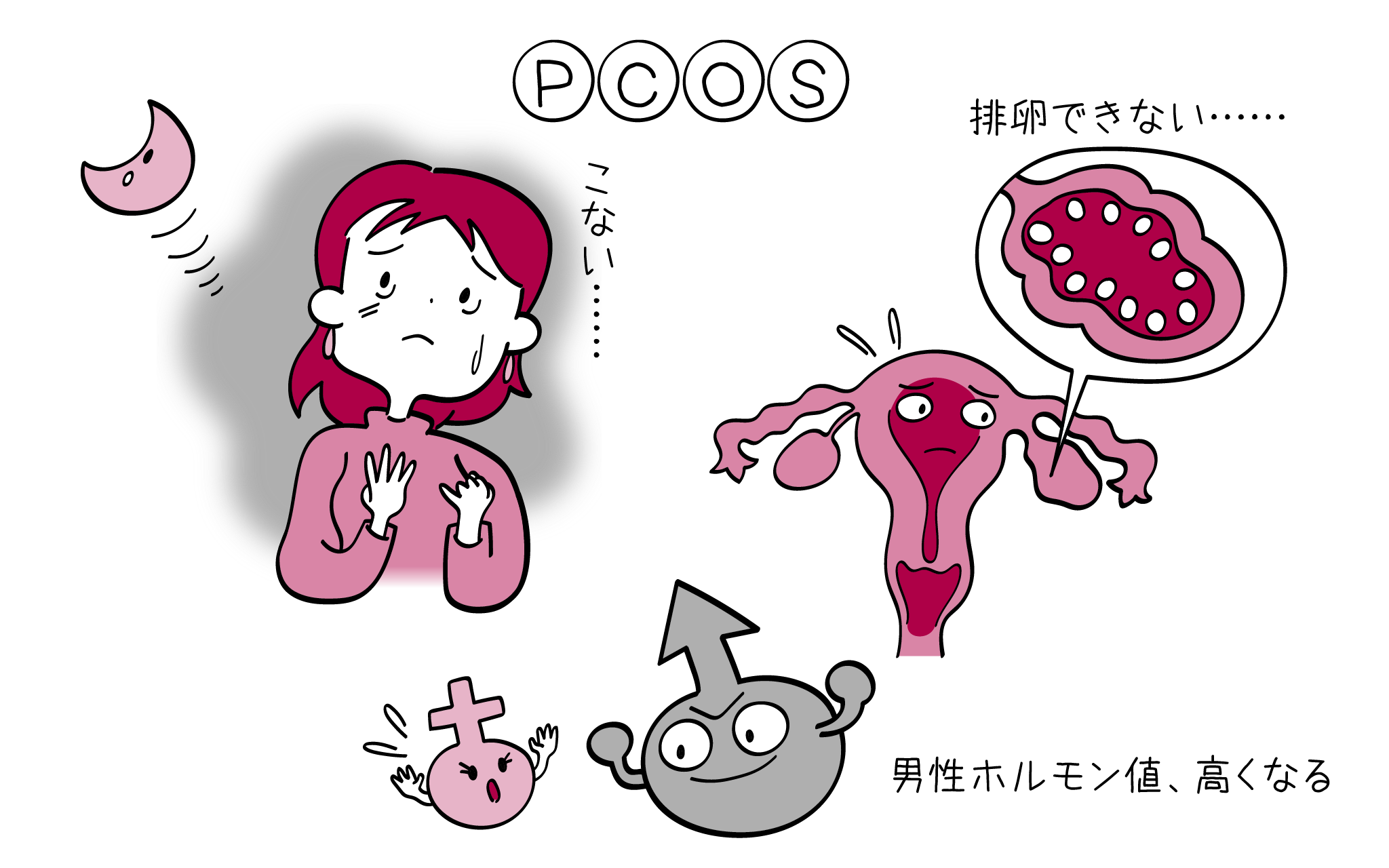 多嚢胞性卵巣症候群の病気の症状・診断・治療を解説するイラスト