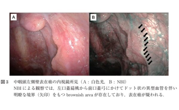 咽頭・喉頭の内視鏡検査所見