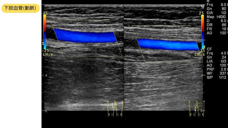 下肢動脈のエコー画像のイメージです。
